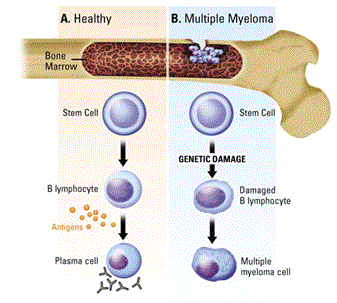 What are the stages of multiple myeloma?